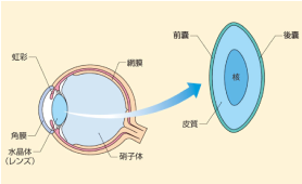 白内障イラスト01