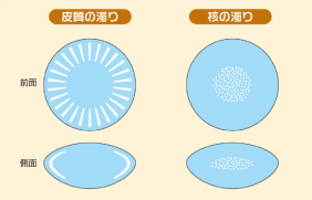 白内障イラスト03